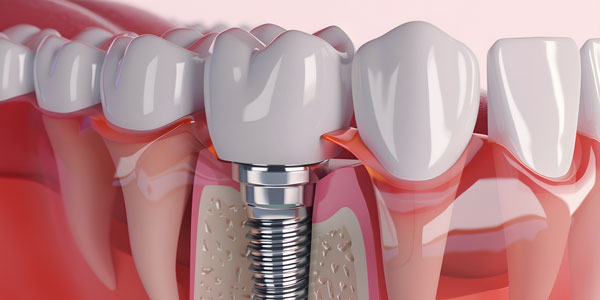 zz_implantat